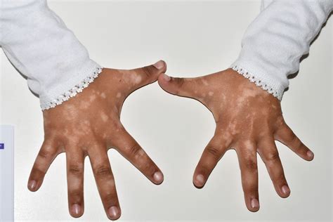 como empieza el vitiligo